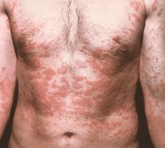 problem skin is a symptom of the presence of parasites