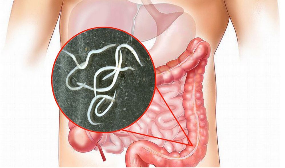intestinal worms