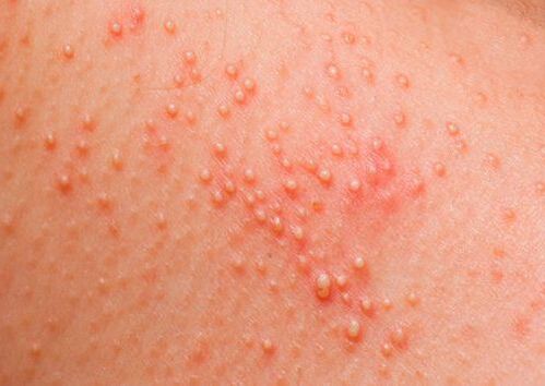 If the body is affected by parasites, skin allergies appear