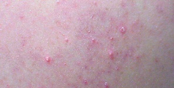 A rash on the body may be a sign of helminthiasis