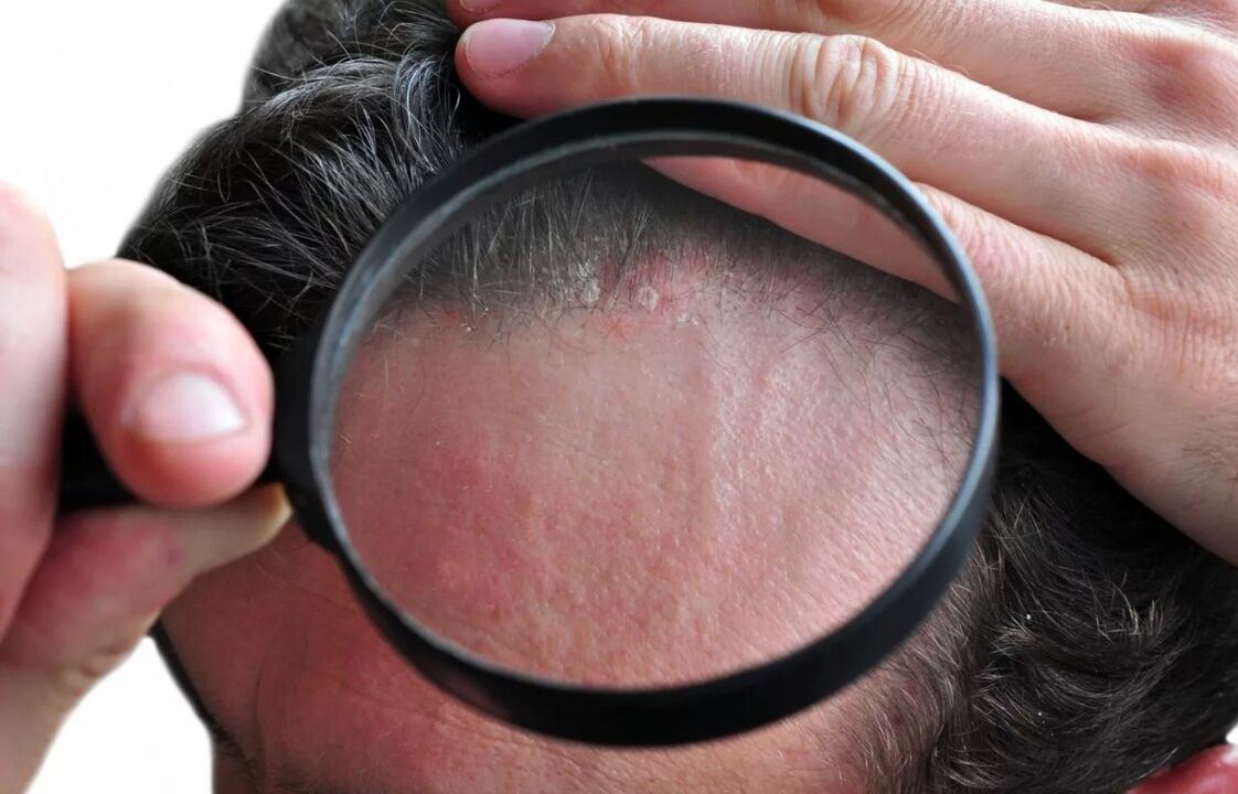 Seborrheic skin